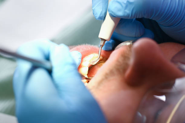 Best Emergency Tooth Extraction in New Market, AL